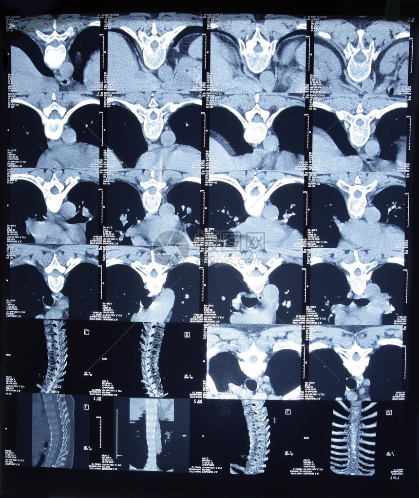 断层扫描仪上的头部和颈部区域的图片图片
