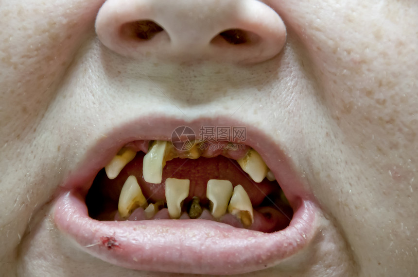 牙齿口严重牙图片