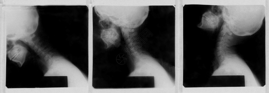 人类颈椎的X射线图像图片