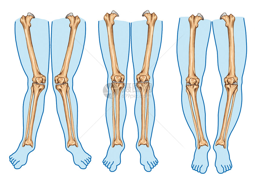 genuvalgum身体腿畸形图片
