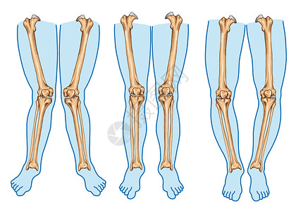 genuvalgum身体腿畸形高清图片