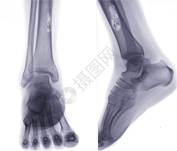 骨癌X光图片