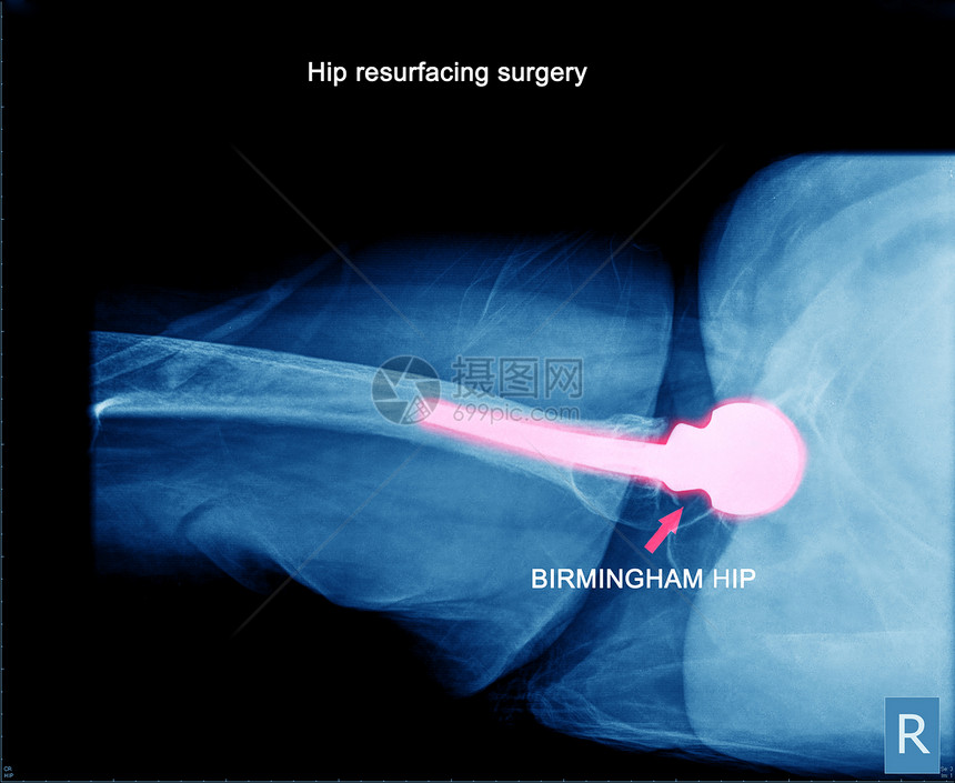 髋关节手术X光片图片