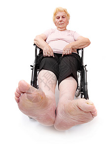 坐在轮椅上的老年瘫痪妇女腿部疾病图片
