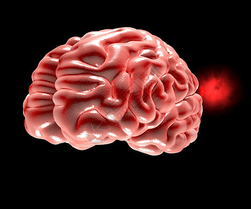 脑动脉瘤扩大脑高清图片