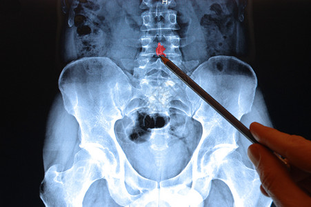 脊椎X光图像Pencil图片