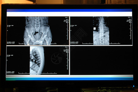 计算机监视器上的人体骨图片