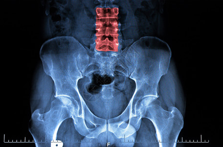 人类骨盆和脊椎的X射线图像下脊椎的红色图片