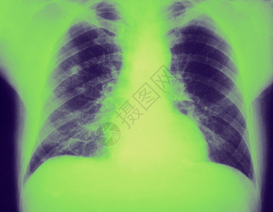 这种动脉前胸X射线透出图片
