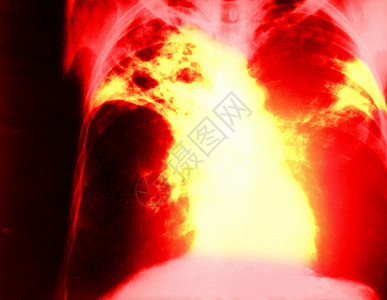 肺结核x艺术图片