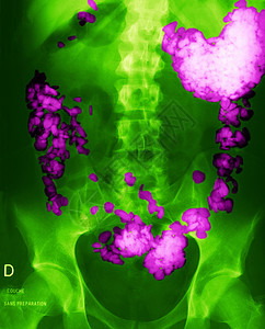胃痛吞下鹅卵石的患者的胃图片
