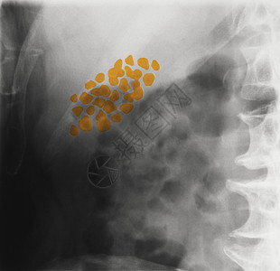 肾结石x光片高清图片