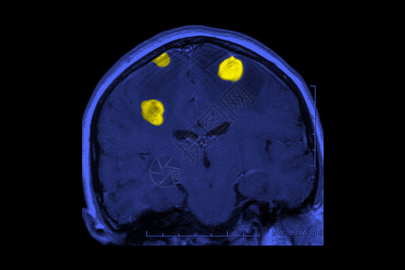 脑癌X射线背景图片