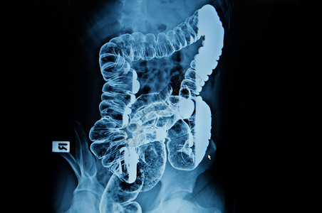 男肺部和脑积水表现出正常图片