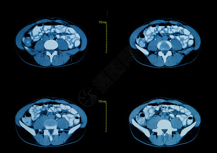 胸部计算机断层扫描医学背景图片