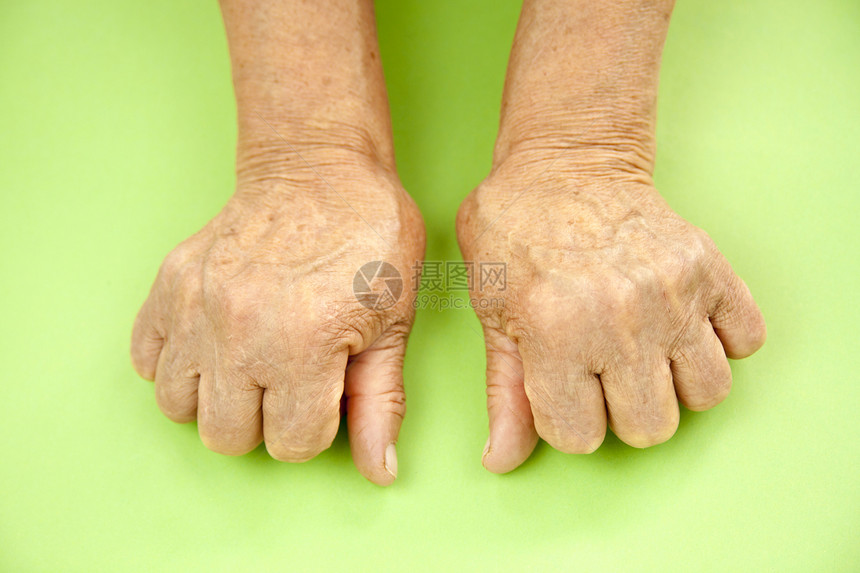 从类风湿关节炎变形的妇女的手绿色背景图片