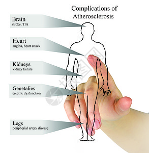 Atherrosc硬化图片
