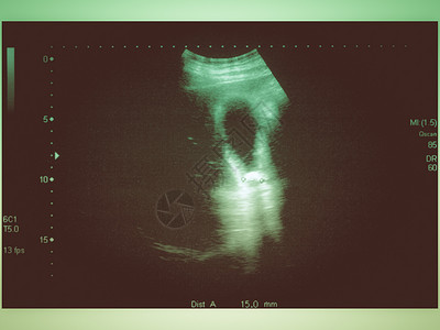 腹部诊断凝结石的超声波扫描图片