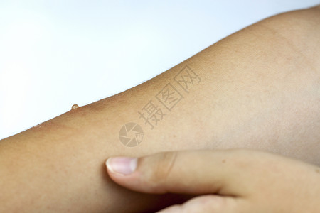 手臂上的麻疹在白色图片