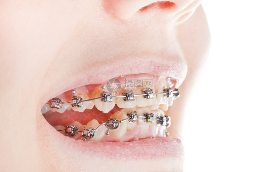 牙齿上的牙套在正畸治疗期间关闭图片