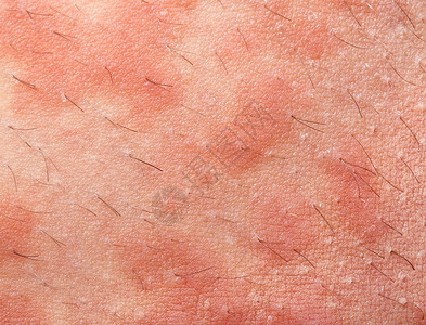 慢性荨麻疹湿疹特应皮炎症状皮肤纹理背景