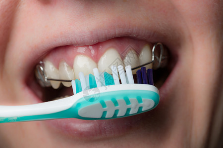 一张带牙套和牙刷的嘴图片