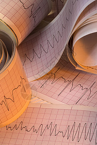 窦性心律包括心室颤动VF和室心动过速VT也称为心律失常背景