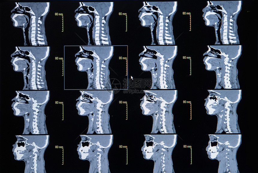 从计算机化颈部宫颈骨XXXXXXX图片