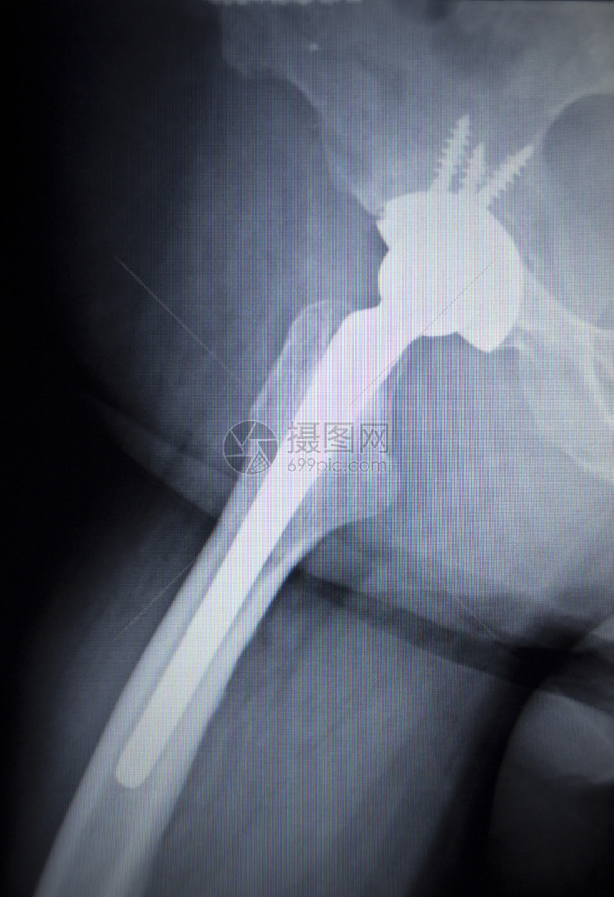 带有骨科髋关节置换植入物头和螺钉的髋关节X射线扫描图像在人体骨骼中以蓝灰色调在骨科创伤外科图片