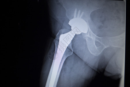 带有骨科髋关节置换植入物头和螺钉的髋关节X射线扫描图像在人体骨骼中以蓝灰色调在骨科创伤外科背景图片