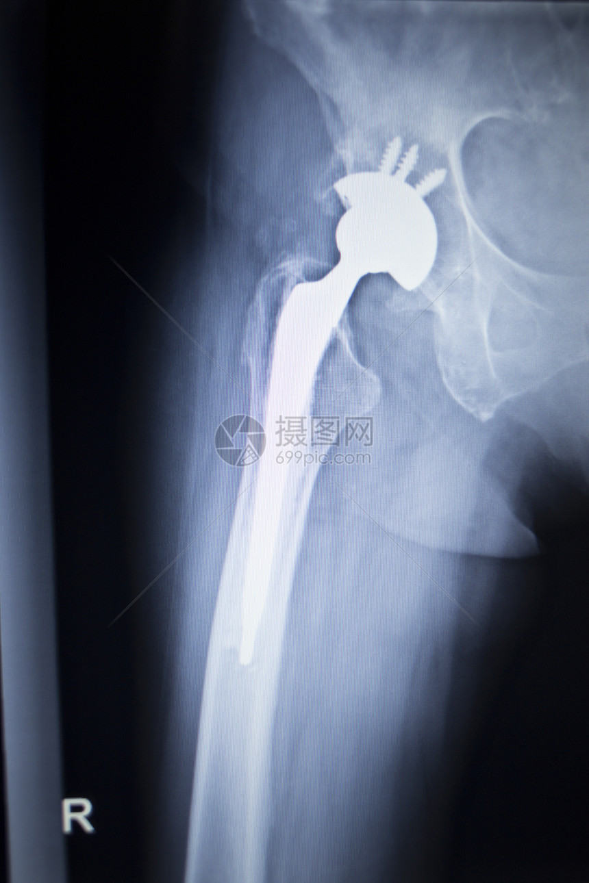 带有骨科髋关节置换植入物头和螺钉的髋关节X射线扫描图像在人体骨骼中以蓝灰色调在骨科创伤外科图片