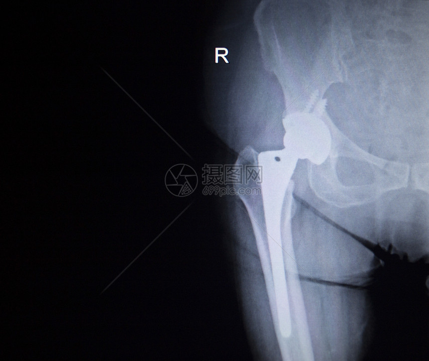 带有骨科髋关节置换植入物头和螺钉的髋关节X射线扫描图像在人体骨骼中以蓝灰色调在骨科创伤外科图片