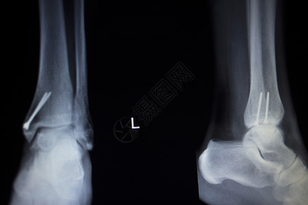 X射线整形医疗CT创伤医院诊所脚部疼痛伤的X光切片扫描并植图片