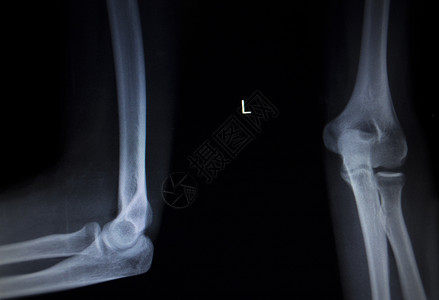 X射线整形医疗创伤医院诊所对痛苦的网球手肘损伤进图片