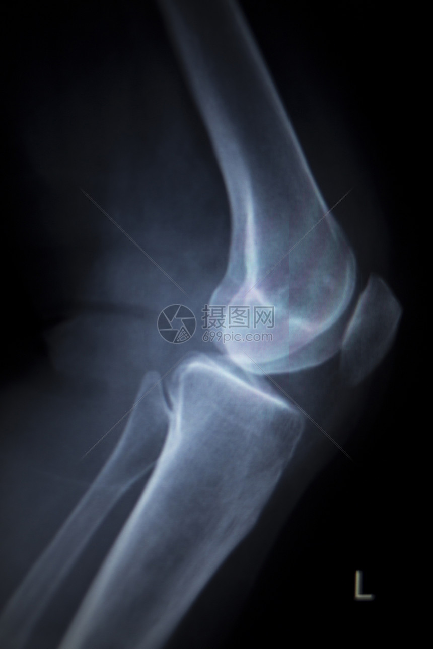 CAT扫描创伤医院诊所疼痛的膝部骨髓损伤腿部图片