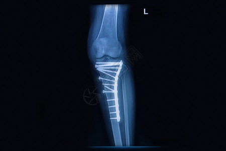 骨质折腿骨的X光四肢骨内部由背景图片