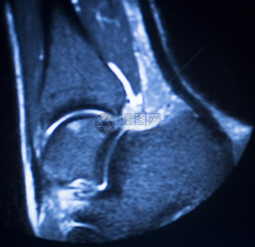 MRI磁共振成像医学扫描测试结果显示脚踝骨骼的颈部卷轴和骨架图片