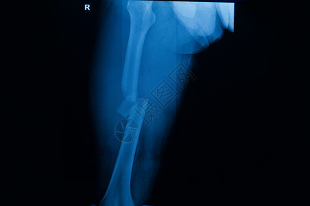 右股骨右大腿拍片X线骨折背景图片