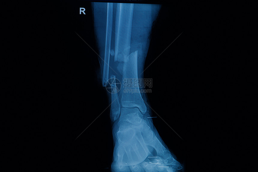 显示右腿骨折的人体X光片集合图片