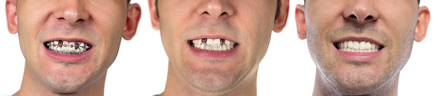 白色背景上有治愈牙齿的男人图片