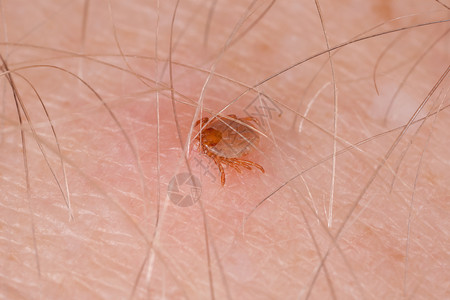 蜱喝血咬人皮肤背景图片