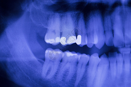 牙科齿补牙口香糖疾病和脑膜炎牙医药物牙齿X射线图片