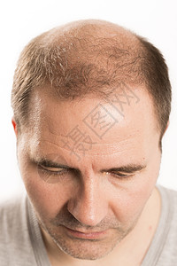 Alopecia男人头发脱理发药物图片