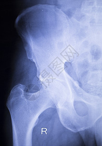 成人病的臀部脊椎和骨盆X光图片