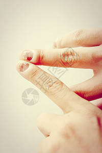 皮肤癣针头感染手指与结球病背景