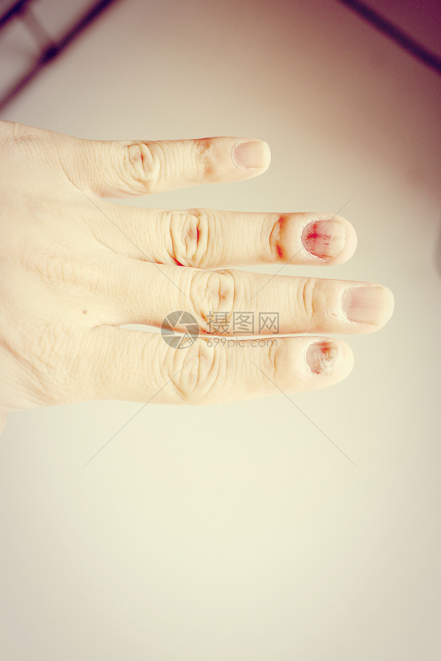针头感染手指与结球病图片