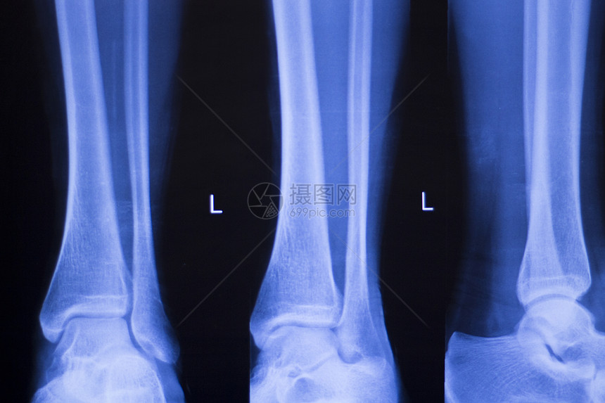 用于诊断运动受伤的脚跟和脚踝X射线创伤学和矫形图片