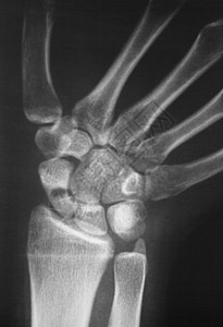 用于诊断运动受伤的手拇指手腕和手指X射线外伤图片