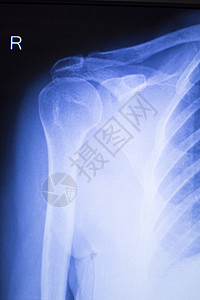 肩部联合受伤X射线创伤学和整形检查用于诊断病人运动伤害的医疗扫描图片