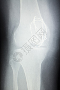 Knee联合电线整形钛金属创伤球和安插老年病人的植图片